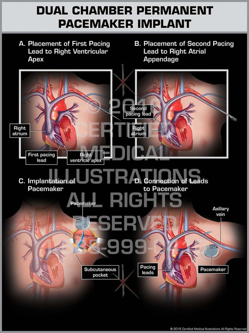 single chamber icd implantation cpt code